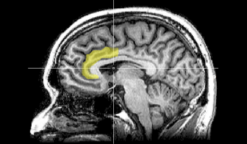 Sagittal MRI slice with highlighting indicating location of the anterior cingulate cortex