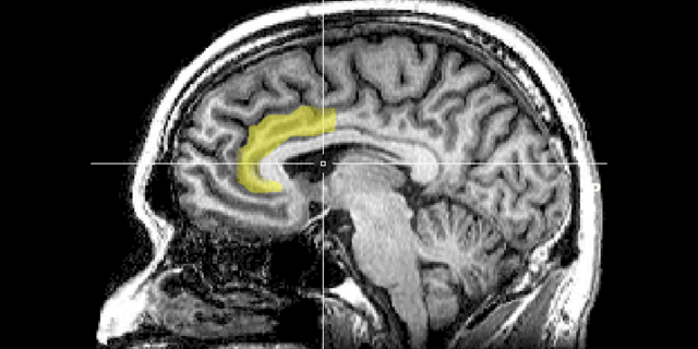Sagittal MRI slice with highlighting indicating location of the anterior cingulate cortex